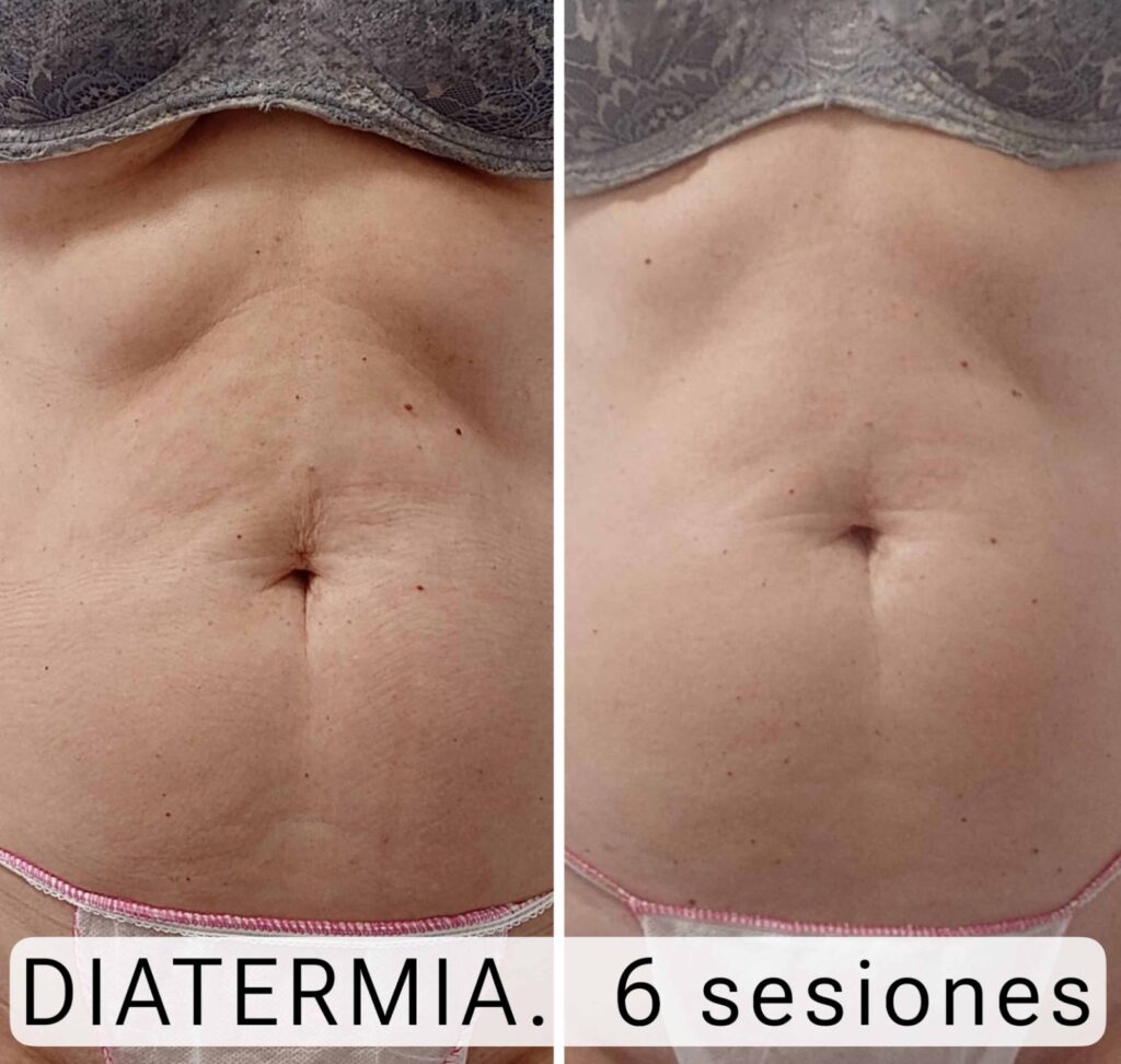 Diatermia resultados en abdomen Diatermia resultados en abdomen