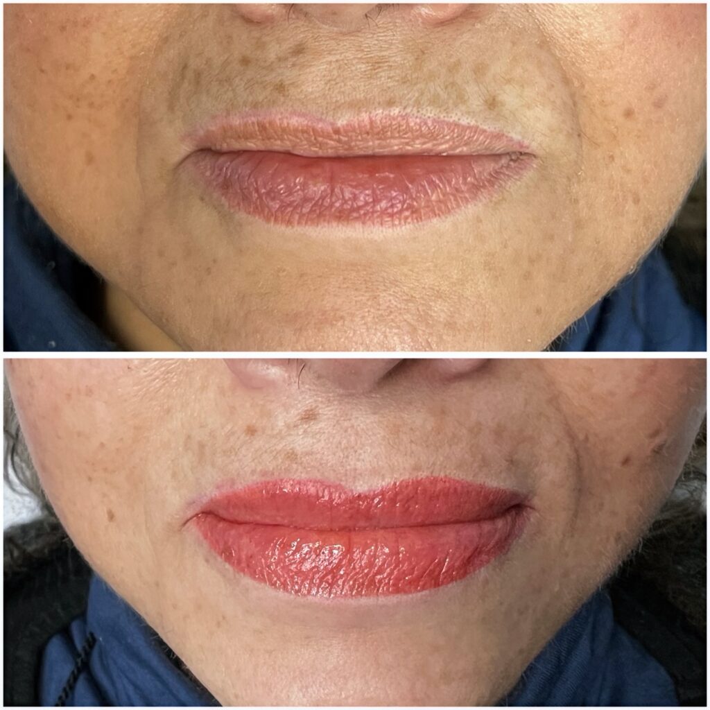 Corrección de labios asimetricos con micropigmentación