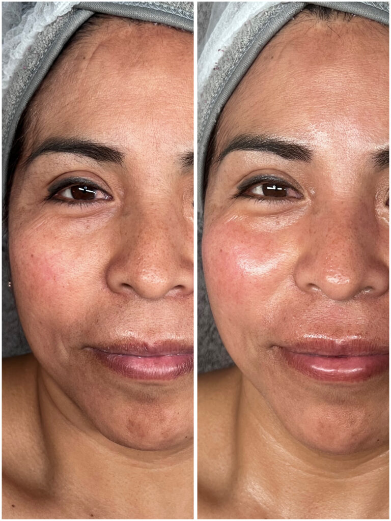 Dermapen vs Diatermia