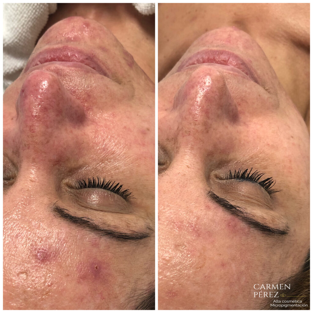 Dermapen vs Diatermia