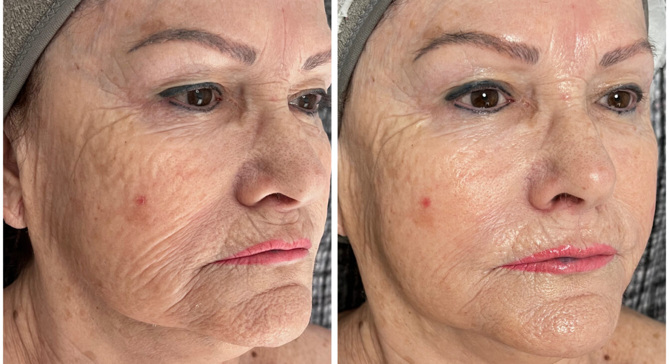 Dermapen vs Diatermia
