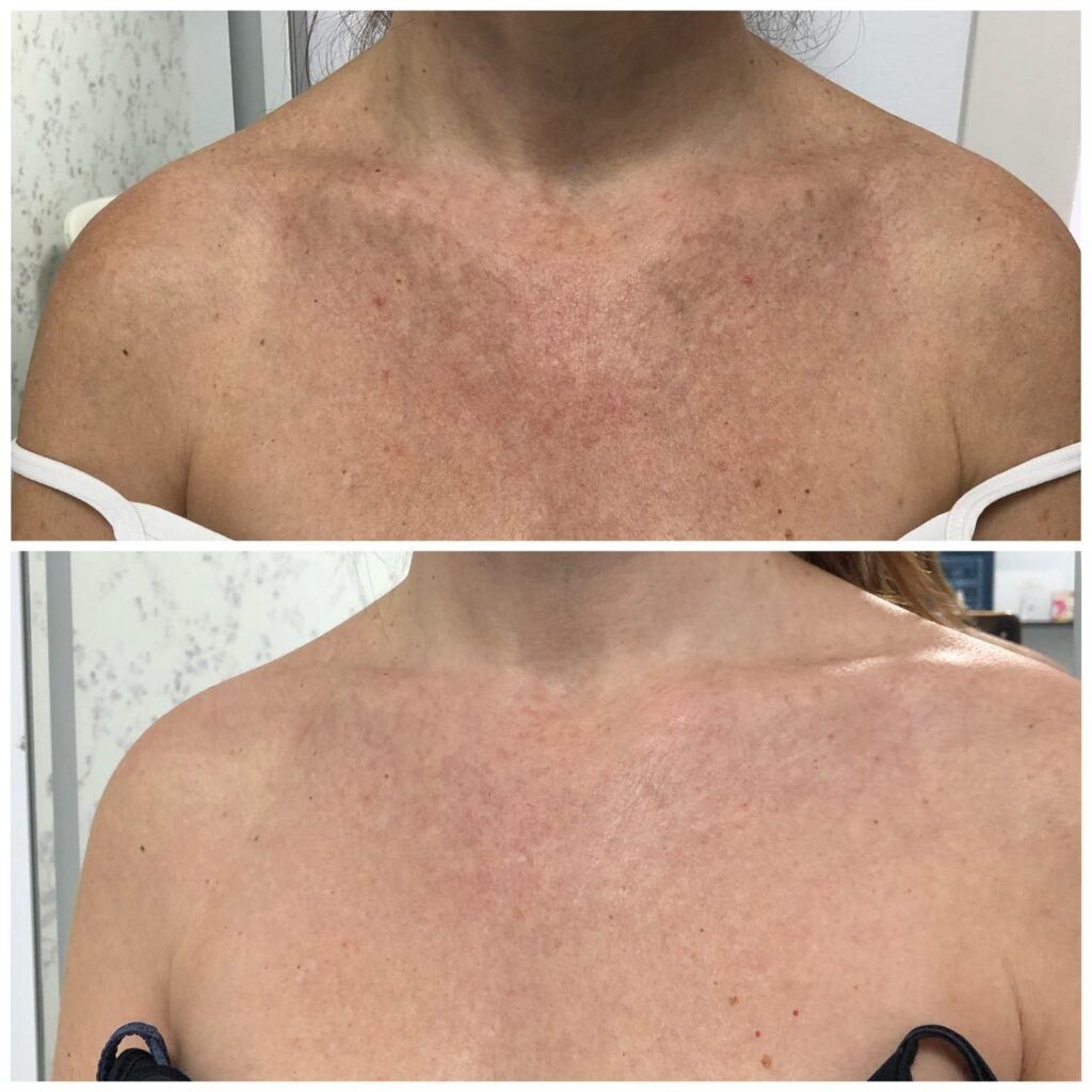 DERMA MELAZERO – tratamiento de manchas Protocolo despigmentante DERMA MELAZERO en cabina