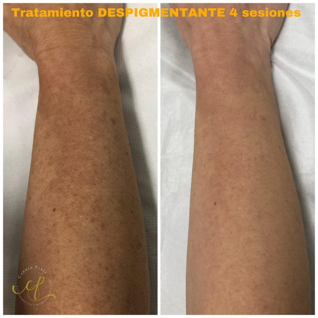 FILLMARK – tratamiento antimanchas premium fillmark-nmn-glutation-e2f1.webp