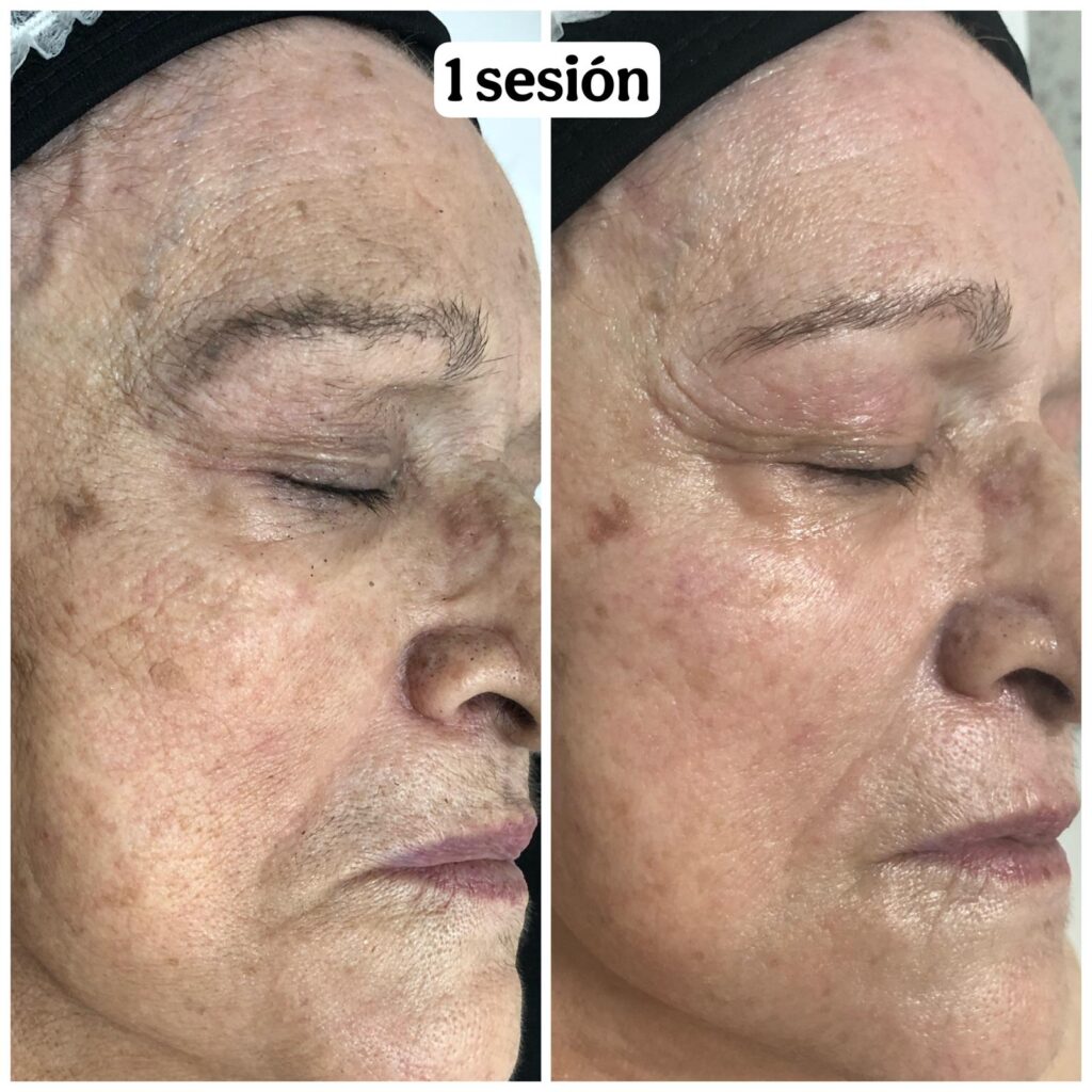 Plan antimanchas para el verano Preparar la piel para el verano: cosmética avanzada y fotoprotección